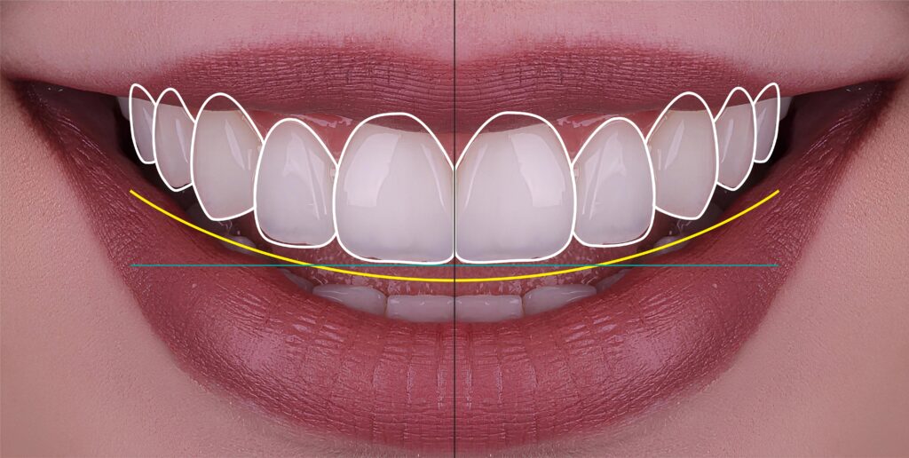 digital smile design shows how a smile makeover can be precisely planned